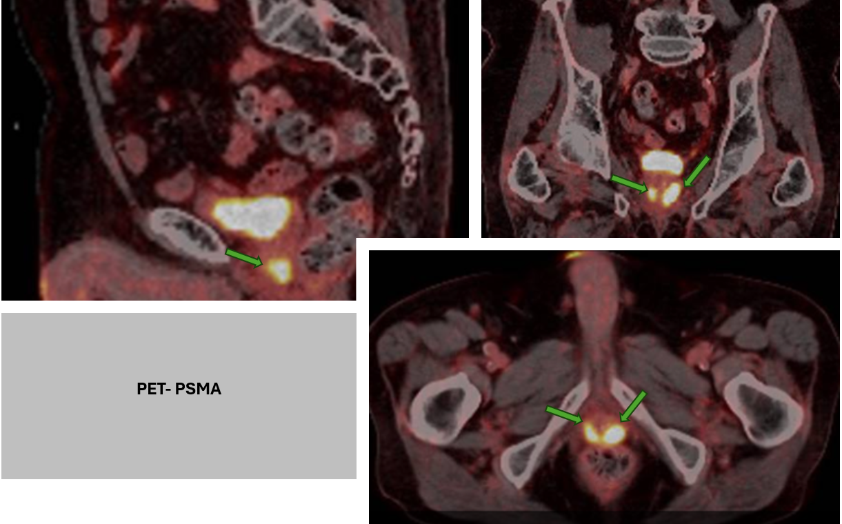 PET-PSMA en ensayos oncologicos - IEC -1