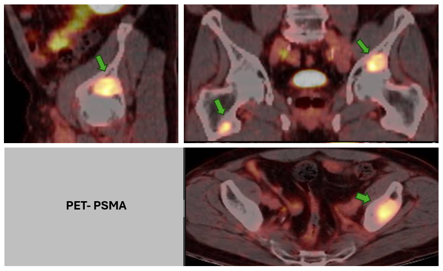 PET-PSMA en ensayos oncologicos - IEC -2